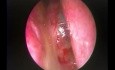 Cholesterinzyste des hinteren Nasenseptums - endoskopische Entfernung