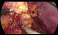 Total laparoskopische Gastrektomie bei einem adipösen Patienten mit Magenkarzinom