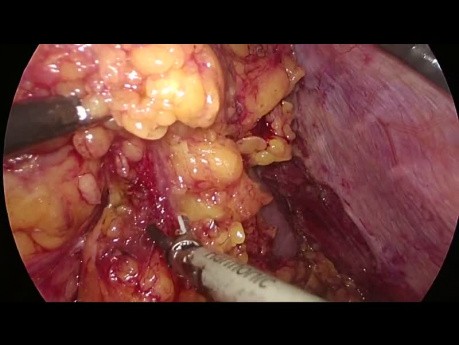Total laparoskopische Gastrektomie bei einem adipösen Patienten mit Magenkarzinom