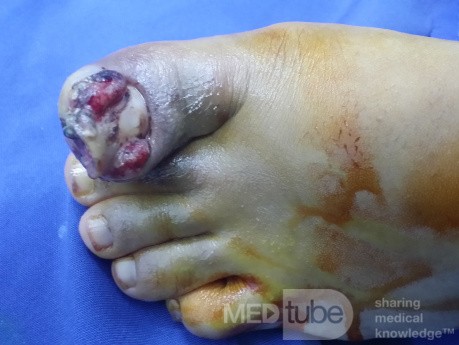 Eingewachsener großer Zehennagel mit Hallux Valgus