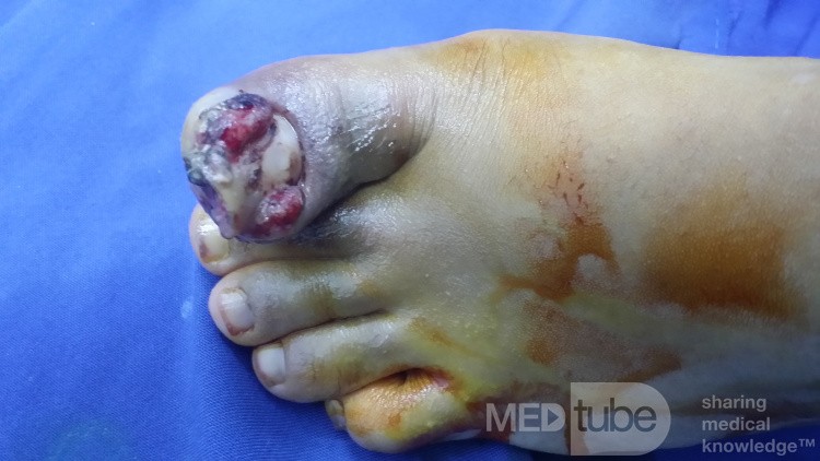 Eingewachsener großer Zehennagel mit Hallux Valgus