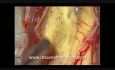 Rückenmarkstumor – zervikal intramedullär – mikrochirurgische Entfernung