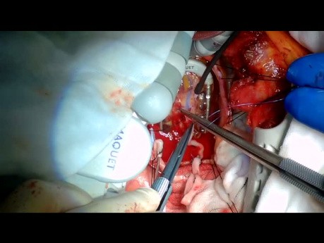 Koronararterienbypass - Reoperation ohne den Einsatz von extrakorporalen Kreislauf