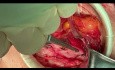 Offene Leistenhernienreparatur
