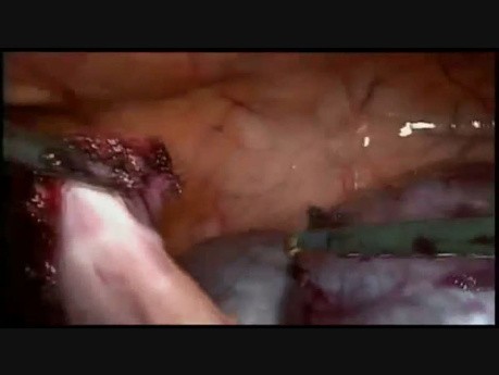 Minimalinvasive Chirurgie zur Behandlung von Beckenzysten