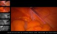 Transabdominelle Präperitoneale Patch-Technik (TAPP) - Tutorial