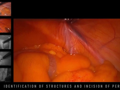 Transabdominelle Präperitoneale Patch-Technik (TAPP) - Tutorial