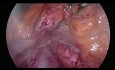 Gemeinsame Leberarterie, die von der oberen Mesenterialarterie (Typ 5) abgeht - während der Pankreatoduodenektomie durch Laparoskopie