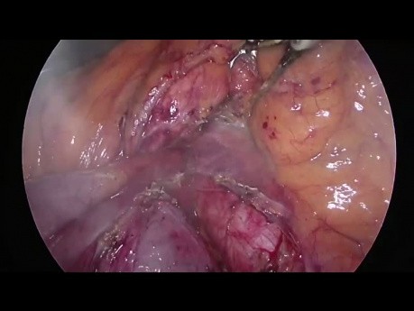 Gemeinsame Leberarterie, die von der oberen Mesenterialarterie (Typ 5) abgeht - während der Pankreatoduodenektomie durch Laparoskopie