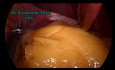 Laparoskopische Sleeve-Gastrektomie mit drei Ports