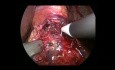 Laparoskopische Heller-Myotomie und Fundoplikatio nach Dor bei rezidivierender Achalasie