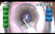 Kataraktoperation an einem 19-mm-Auge