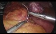 Mini-Magenbypass + Nissen-Fundoplikatio + Reparatur von Hiatushernien