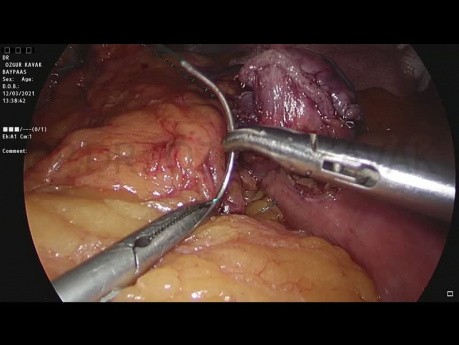 Mini-Magenbypass + Nissen-Fundoplikatio + Reparatur von Hiatushernien