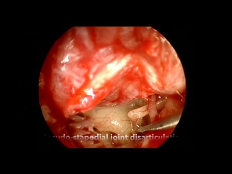Endoskopische Stapedotomie bei Otosklerose (Mikrobohrer)