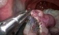 Transanale minimal-invasive Chirurgie (TAMIS) und endoskopische Submukosadissektion (ESD) eines Rektumadenoms