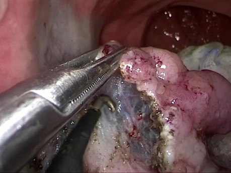 Transanale minimal-invasive Chirurgie (TAMIS) und endoskopische Submukosadissektion (ESD) eines Rektumadenoms