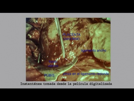 Abdominalgravidität