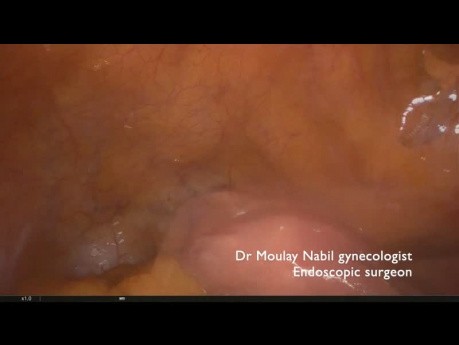 Laparoskopische Adnexektomie zur Behandlung von Ovarialtorsion
