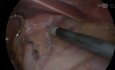 Reoperation bei Hiatushernie