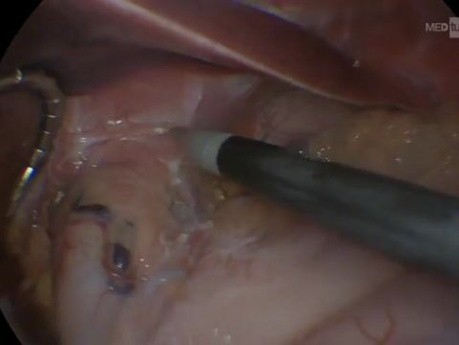 Reoperation bei Hiatushernie