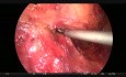 Laparoskopische vordere Resektion mit Hernienreparatur