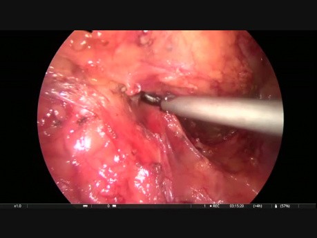 Laparoskopische vordere Resektion mit Hernienreparatur