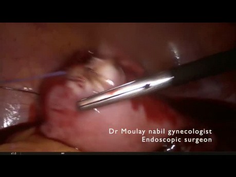 Herausfordernde laparoskopische Myomektomie
