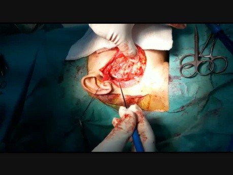 Intraoperative Überwachung der Funktion des Gesichtsnervs während der Paroidektomie