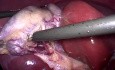 Blutungsarme laparoskopische Cholezystektomie