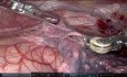 Roboter-assistierte Thymektomie bei Myasthenia gravis