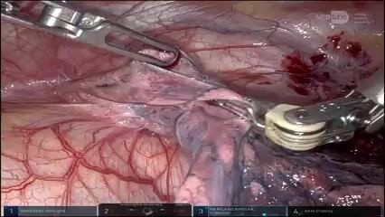 Roboter-assistierte Thymektomie bei Myasthenia gravis