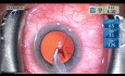 Kataraktchirurgie mit Glaukom-Mikrostent – ​​ungeschnittene Lehrausgabe