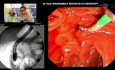 ERCP: Platzierung eines selbstexpandierenden Metallstents (SEMS) bei fortgeschrittenem Pankreaskarzinom