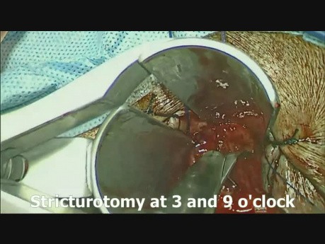  S.T.A.R.R.-Operation ­ Stapled Trans Anal Rectum Resection