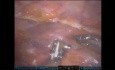 Roboterassistierte minimalinvasive Aortokoronare Bypassoperation (CABG) mit beidseitigen thorakalen Arterien