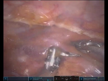 Roboterassistierte minimalinvasive Aortokoronare Bypassoperation (CABG) mit beidseitigen thorakalen Arterien