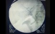 Intraoperative Cholangiographie (IOC)
