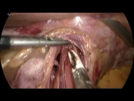 Laparoskopische Heller-Myotomie
