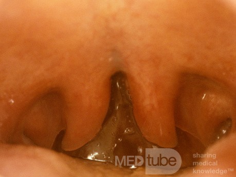 Uvula bifida