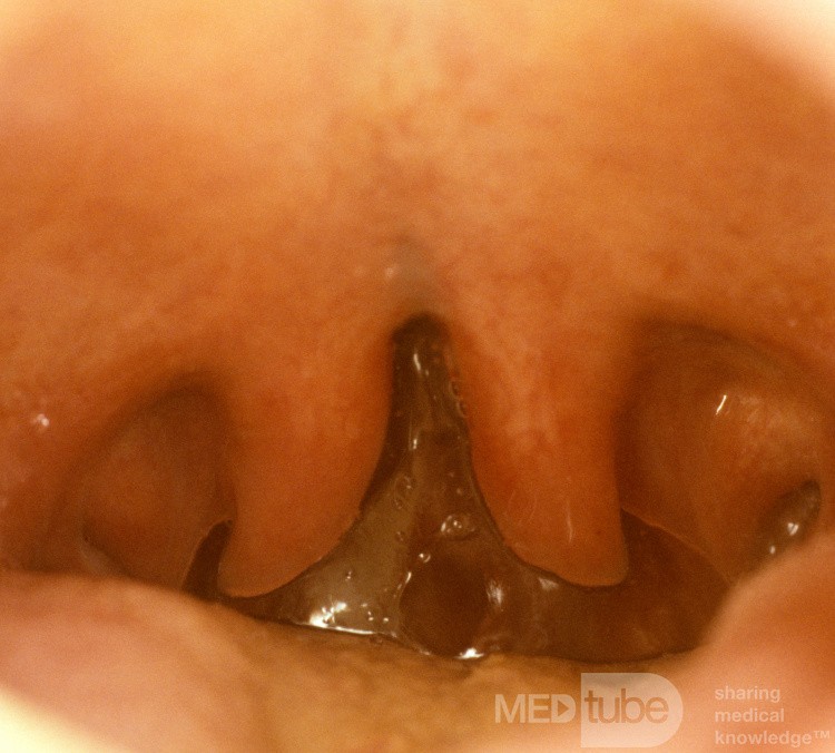 Uvula bifida