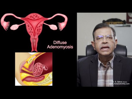 Myom und Adenomyose – was ist der Unterschied?