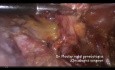 Totale hysterektomie und Ovarialtransposition bei dem Zervixkarzinom