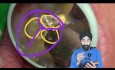Extraktion eines oberen Molaren durch Sektionierung und Anhebung, 4K POV mit Jazs Kommentar