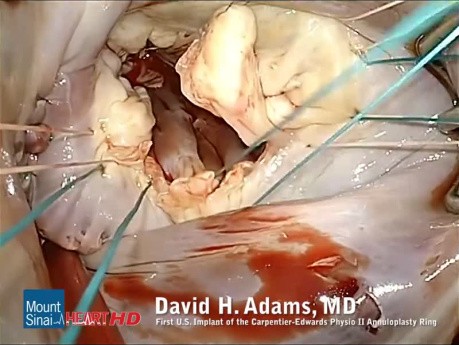 Mitralklappenreparatur mit dem ersten Implantat des Physio II Annuloplastierings in den USA