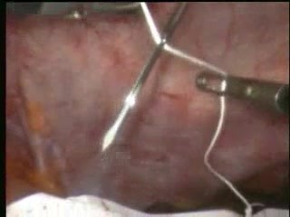 Laparoskopische Reparatur der Bauchhernie 