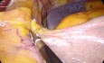 Mini-Gastric Bypass