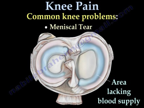 Typische Ursachen für Knieschmerzen