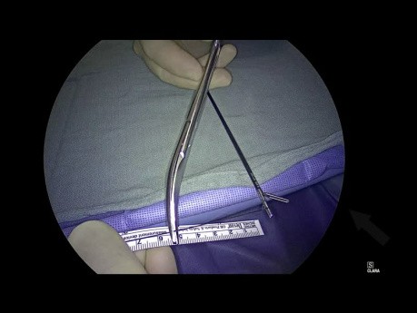 Geometry Fundoplication App Tutorial: Teil 6. "Nahtlineal"