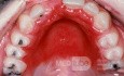 Candidose am harten Gaumen als Folge von Zahnersatz